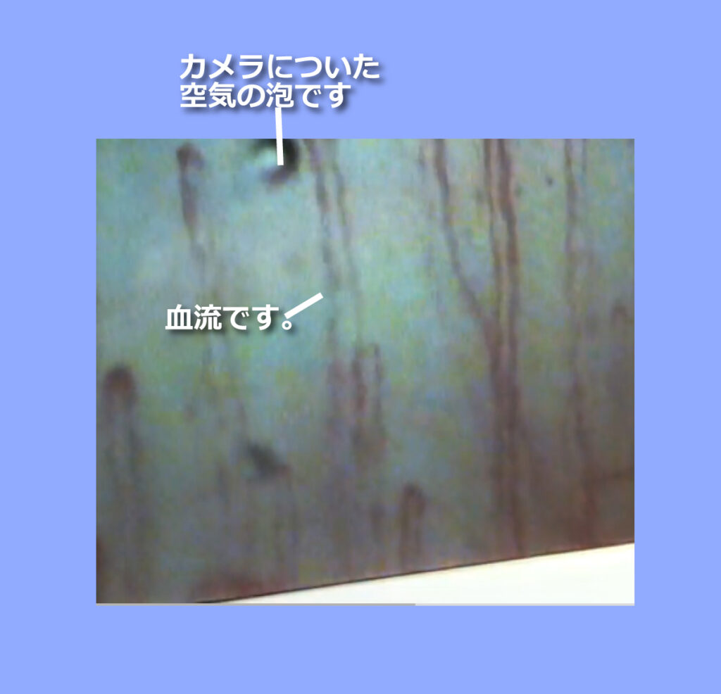 スーパーSP100 血管の中 特許 高血圧